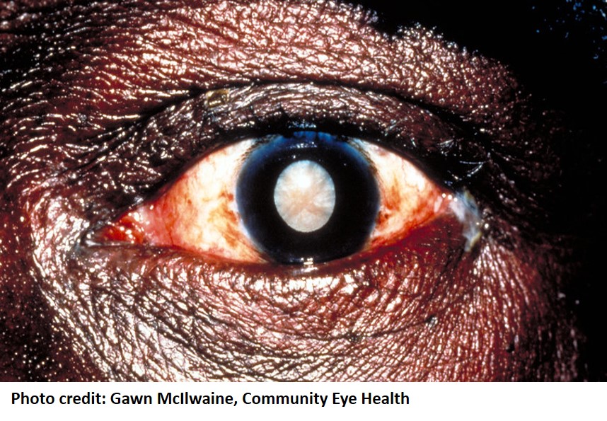 June is Cataract Awareness Month || Eyehub Nigeria